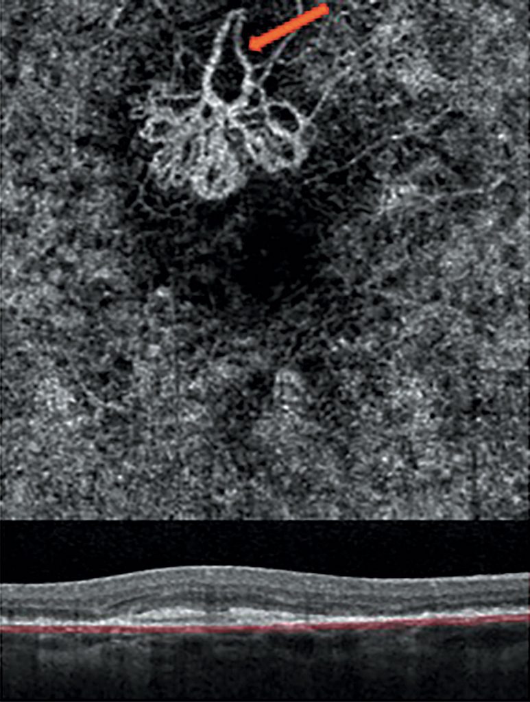 Angiographie-OCT en pratique clinique : un formidable outil ...