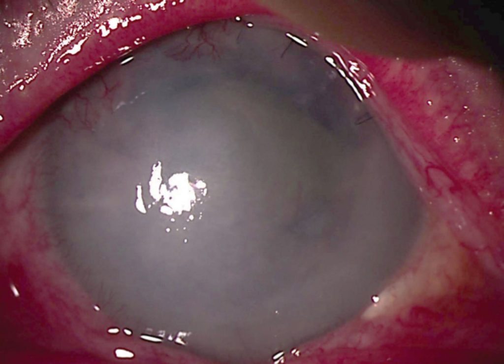 Negatif Pour Une Lesion Intra Epitheliale Ou Maligne
